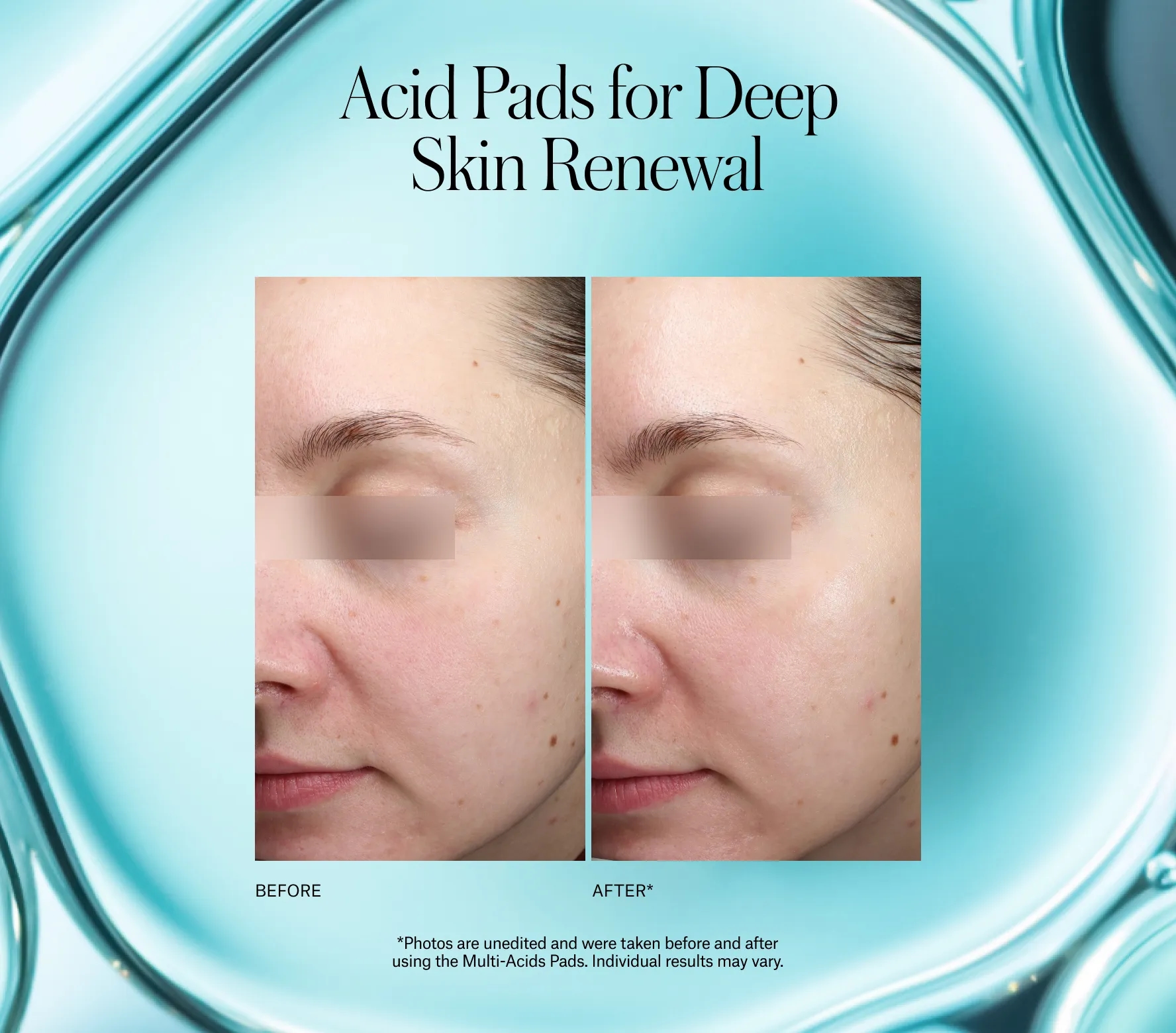 Resurfacing Multi-Acids Pads Next-Gen